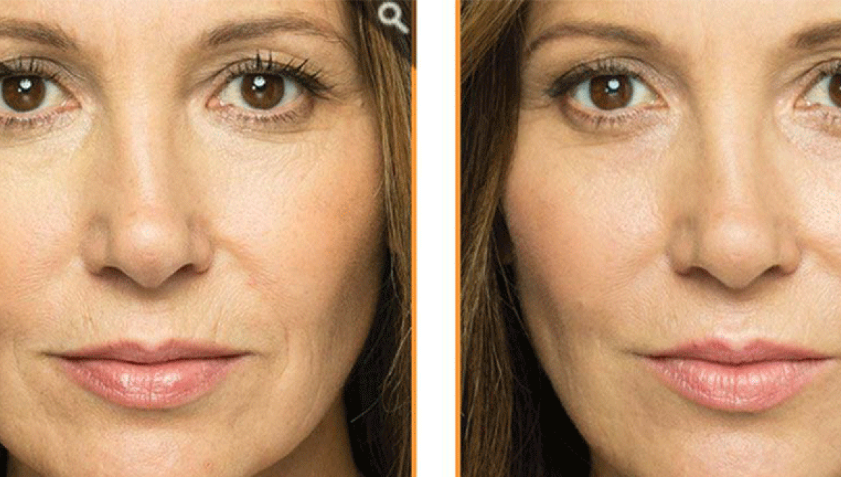 Before and after image of Belotero treatment.
