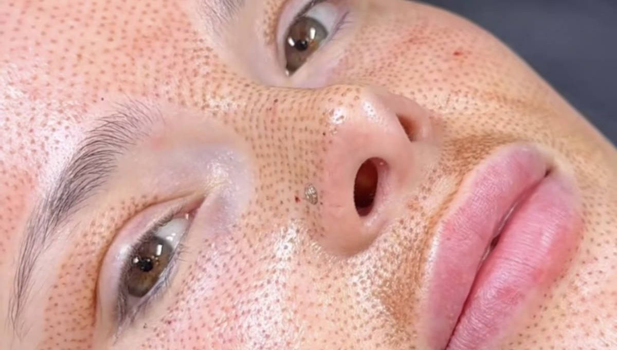 Patient shoing Fibroblasting a skin tightening procedure